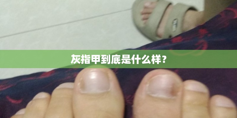灰指甲到底是什么样？