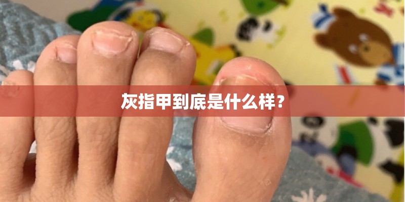 灰指甲到底是什么样？